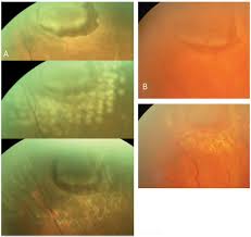 The vast majority of retinal tears are treated with laser photocoagulation. A Field Guide To Retinal Holes And Tears