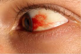 Blepharitis (entzündung der ränder des augenlids). Augenverletzungen Wann Zum Arzt Gesundheitsoptik