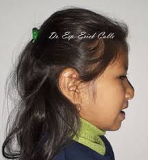 Mordida cruzada anterior: Diagnóstico y tratamiento con Placa Modelador  Elástico de Bimler de Progenie