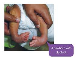 There is currently no known. Treating Clubfoot Positive Parenting