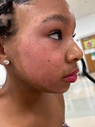 Any natural remedies for eczema relief?