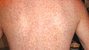 More than 65% of patients with mononucleosis experienced rash. Mono Rash Itchy Infectious Mononucleosis