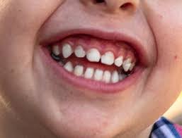 Il est également important de veiller à son alimentation pour éviter les excès de sucre et le grignotage. Faire Tomber Les Dents De Lait En Douceur Picou Bulle Blog De Maman Decomplexe Et Bienveillant Lyon