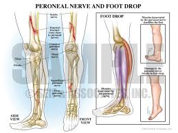 Foot Drop Foot Drop Compartment Syndrome Ankle Anatomy