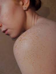 Image result for Dry Skin