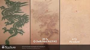 Best austin laser tattoo removal. Tattoo Removal Rancho Wellness Aesthetics