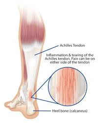 The Achilles Tendon Connects The Calf Muscles In The Back Of Your Leg To Your Heel The Tendon Can Become Inflamed With Achilles Tendonitis Tendinitis Achilles