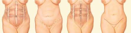 Check spelling or type a new query. Abdominoplasty Surgery In Richmond Short Pump Va