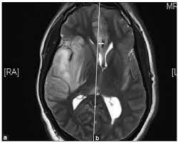 Magnetic resonance imaging (mri) revealed a newly identified enhancing left sphenoid wing meningioma with peritumoral edema in the underlying brain (figure 1). Decompressive Craniectomy In Herpes Simplex Encephalitis
