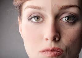 Zmarszczki palacza czyli zmarszczki wokół ust (absolutnie nie ograniczone tylko do grupy osób palących) stanowią realny problem estetyczny, ponieważ są umiejscowione w dynamicznym i narażonym na spojrzenia rejonie twarzy, cechującym się cienką skórą i warstwą podskórną. Usun Zmarszczki Palacza Domowe Sposoby Poradyfit