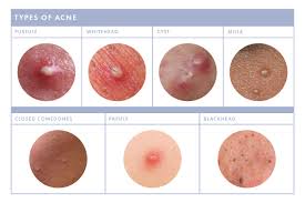 This pesky subgroup of acne may not be as pronounced as visibly inflamed also, not every whitehead needs to have a white dot at its center; How To Treat Whiteheads On The Face So Your Skin Can Be Clear And Bump Free