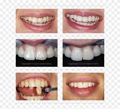 Advanced dental clinic in pune. Tooth Beaconsfield Buckinghamshire Court Dental Clinic Lip Gloss Clipart 4051800 Pikpng