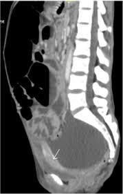 Benign mesothelioma is a tumor that isn't cancerous and doesn't spread to other parts of the body. Benign Cystic Peritoneal Mesothelioma Revealed By Small Bowel Obstruction