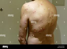 Image result for Cimex lectularius bites