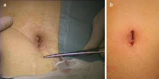 Image result for Umbilicus botryoides
