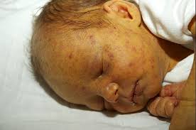 Learn about leukemia from the cancer experts. Perilous Pinhead Polka Dots Litfl Clinical Cases Paediatric