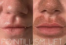 Pin By Vanessa Teixeira On Fibroblast It Tighten Facial Skin Skin Tightening Treatments Lip Wrinkles