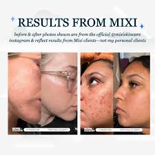 HALEY GAGNON ♥ ACNE SPECIALIST LAKE MARY FL (@modernskin.aesthetics) •  Instagram photos and videos