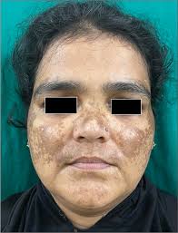 Image result for Diffuse Hyperpigmentation