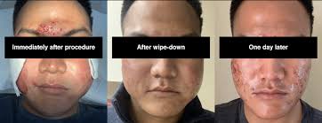 My acne scars treatment journey: Infini with Dr Weiner and  CROSS/Subcision/Microneedling with Dr Rullan [pics!]