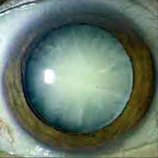 In the 19th century, german black cataract meant gutta serena (q.v.). Pkw Fahrtauglichkeit Ab Dem 50 Lebensjahr Sicherheit Im Strassenverkehr Der Augenoptiker