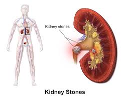 How To Treat Kidney Stones Naturally Kidney Stones Remedy Treat Kidney Stones Signs Of Kidney Stones
