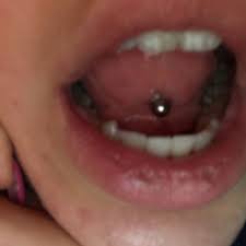 Zungenpiercing Unten Eiter Normal Schmerzen