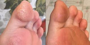 Check spelling or type a new query. Amazon Customers Love This Foot Cream For Dry Cracked Skin