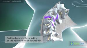 However, for some, the whiplash injury can be more serious and result in a long time off work. Predicting Outcomes In Whiplash Physiopedia