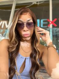 Vitiligo Facts: Vitiligo can affect eyes, sometimes causing increased  sensitivity to light, dry eye syndrome, and iris or retinal pigment  changes. That's why I keep a cute pair of sunglasses. #vitiligo #sunglasses  #