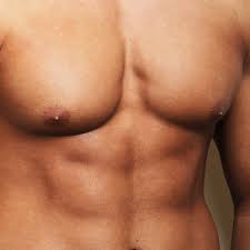Image result for Gynecomastia