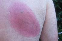 Jun 07, 2021 · west nile virus is spread to people through the bite of an infected mosquito. Lyme Disease Rash