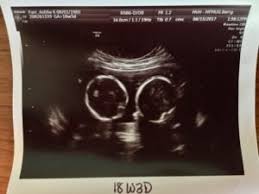 The presence of a heartbeat is seen as a very positive sign. Did You Find Out It Was Twins At Later Ultrasound Twin Ultrasound Twiniversity