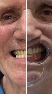 Experience the transformation with Noel Mulvaney as he shares his journey  to 9 crowns + denture. Witness the power of a radiant smile and renewed  confidence. 🌟 #NoelMulvaneySmile #DentalTransformation ...