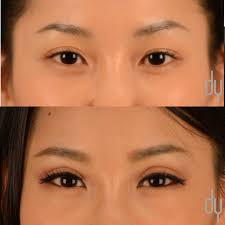 Choose a procedure below to explore before and after photos from aesthetic society surgeons on our new site, smartbeautyguide.com. Asian Eyelid Surgery Asian Blepharoplasty Eyelid Surgery Eye Surgery Korean Eye Surgery