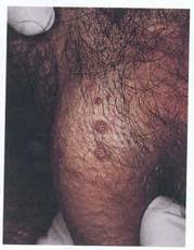 Recognizing signs and symptoms of hpv 1. How To Tell If You Have Genital Warts Male