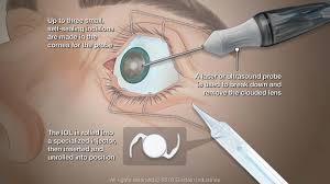 Image result for Cataract Extraction
