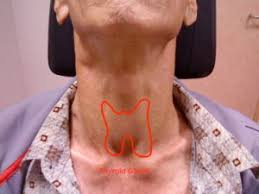 If you have symptoms of hyperthyroidism or hypothyroidism, or feel a lump or swelling in your thyroid, it is best to see a primary care provider who will perform a basic examination and may check your thyroid function using a blood test. What Does Cancer Of The Thyroid Look Like
