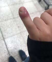 Image result for Akutní zánět nehtového lůžka