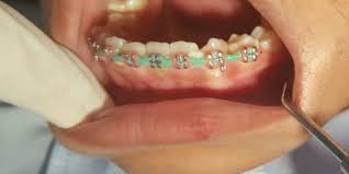 Maybe you would like to learn more about one of these? Pakai Behel Palsu Jawaban Si Anak Bikin Dokter Ngelus Dada Dream Co Id