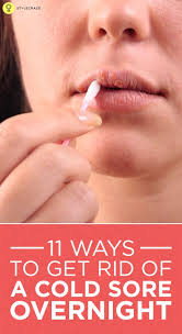 11 Ways To Get Rid Of A Cold Sore Overnight Cold Sore Blister Remedies Cold Sores Remedies