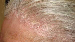 Symptoms include brittle hair and nails, hair loss, and dry skin. Dandruff Vs Psoriasis How To Tell The Difference