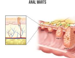 Image result for genital warts