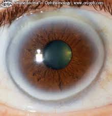 Why is there a blue ring around my eye? Blue Ring In Eye What To Do When You Have Heart Disease Blog