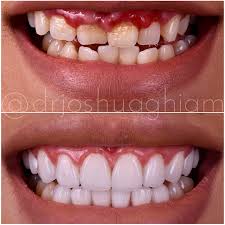 One veneer definition from a medical dictionary is: Porcelain Veneers Los Angeles Dental Veneers Cosmetic Dentist