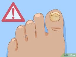 Available on the following languages: Cara Membantu Kuku Kaki Tumbuh Kembali 15 Langkah Dengan Gambar