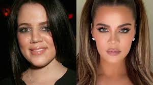Khloé kardashian opens up about her migraines. Khloe Kardashian S Plastic Surgery Secrets Revealed Nz Herald