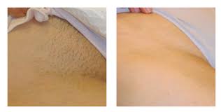 Visit our hair removal page for more information. Bikini Laser Hair Removal Cost Off 62 Online Shopping Site For Fashion Lifestyle