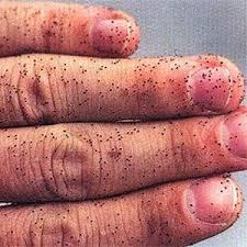 Bird Mites In Hair Can Bird Mites Live On Humans Birdmiteguide Mites On Humans Mites On Chickens Chicken Nesting Boxes