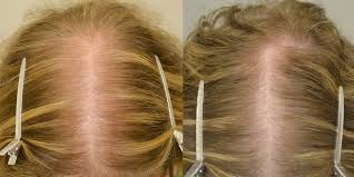 They recommend using the treatment for at least 6 months. Spironolactone Hair Restoration Of The South New Orleans La